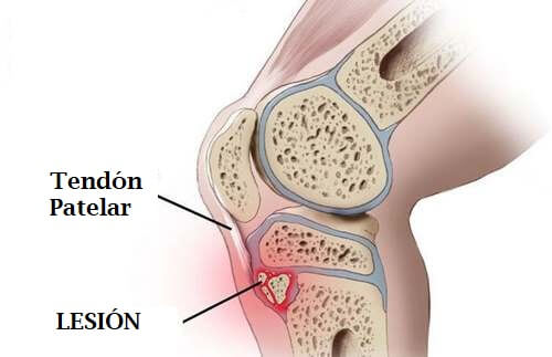 lesión en niños de Osgoog-Schlatter