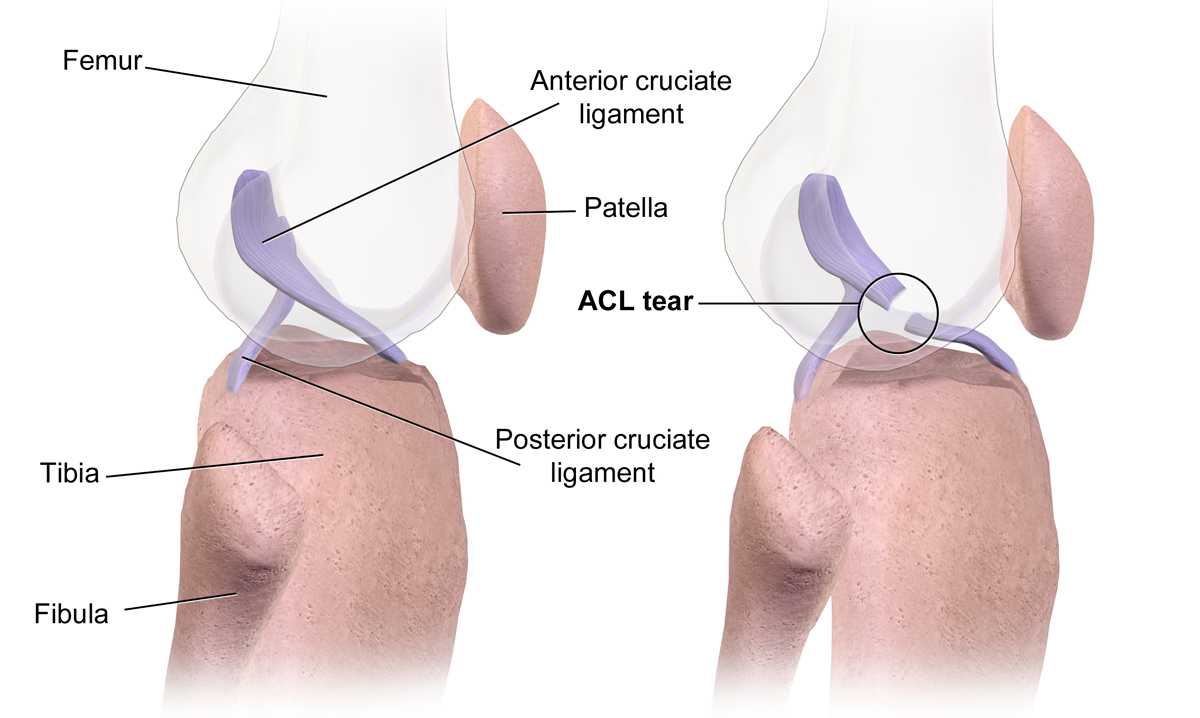 ACL tears are becoming more common child sports injuries