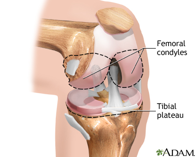 Growth plate fractures are common child sports injuries